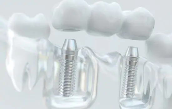 Dental Implants Katy Texas